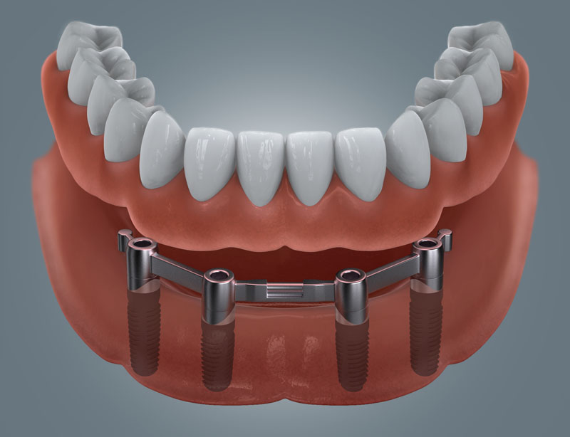 Zahnloser Unterkiefer mit Stegversorgung