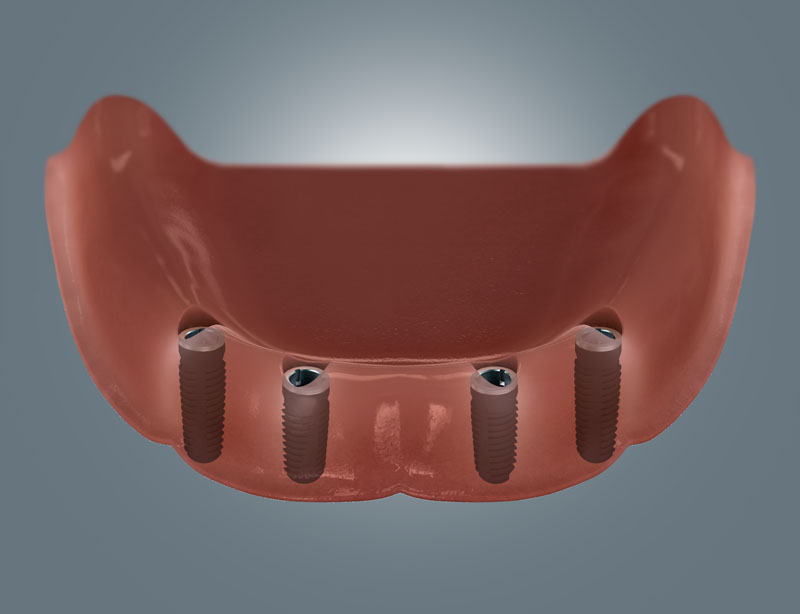Zahnloser Unterkiefer mit Implantaten
