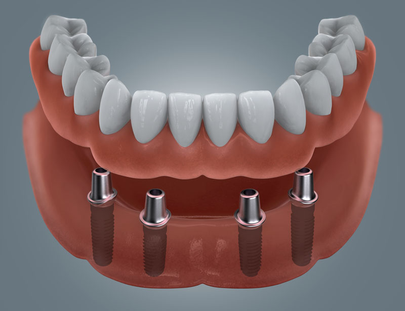 Zahnloser Unterkiefer mit Doppelkronenversorgung