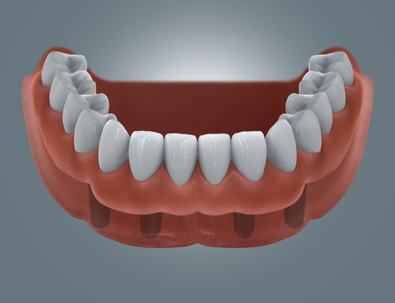 Zahnloser Unterkiefer mit aufgesetzter Prothese